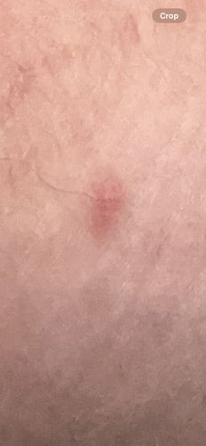 It is not possible to identify an insect from this image. The image shows a small red mark on human skin, possibly an insect bite, but no insect is visible for identification.