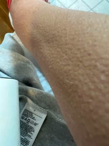 Goosebumps (Piloerection)