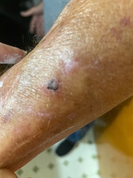 Hard-bodied tick (embedded)