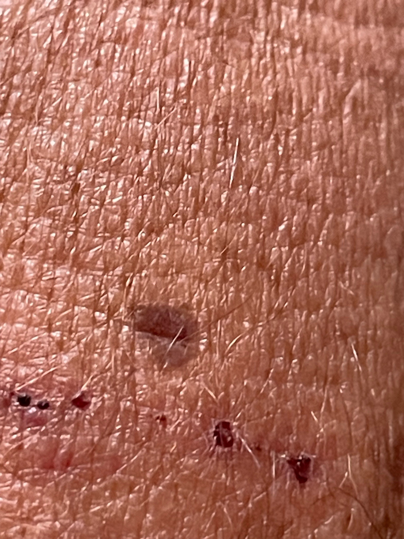Human Bed Bug