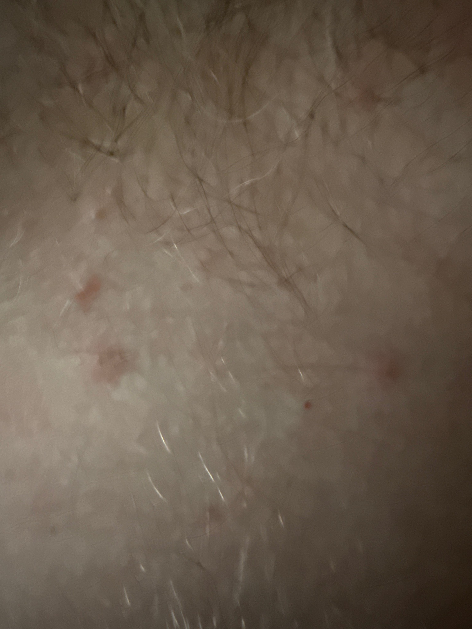 Itch mite (Scabies mite)