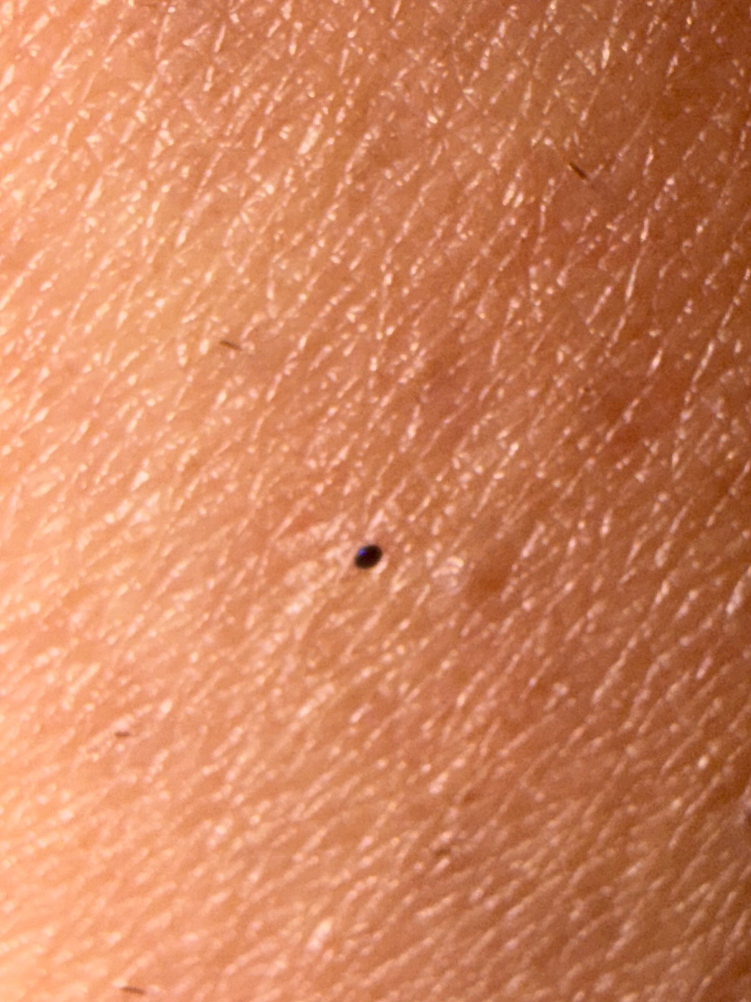 Likely blacklegged (deer) tick nymph