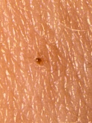 Likely chigger (harvest mite larva)