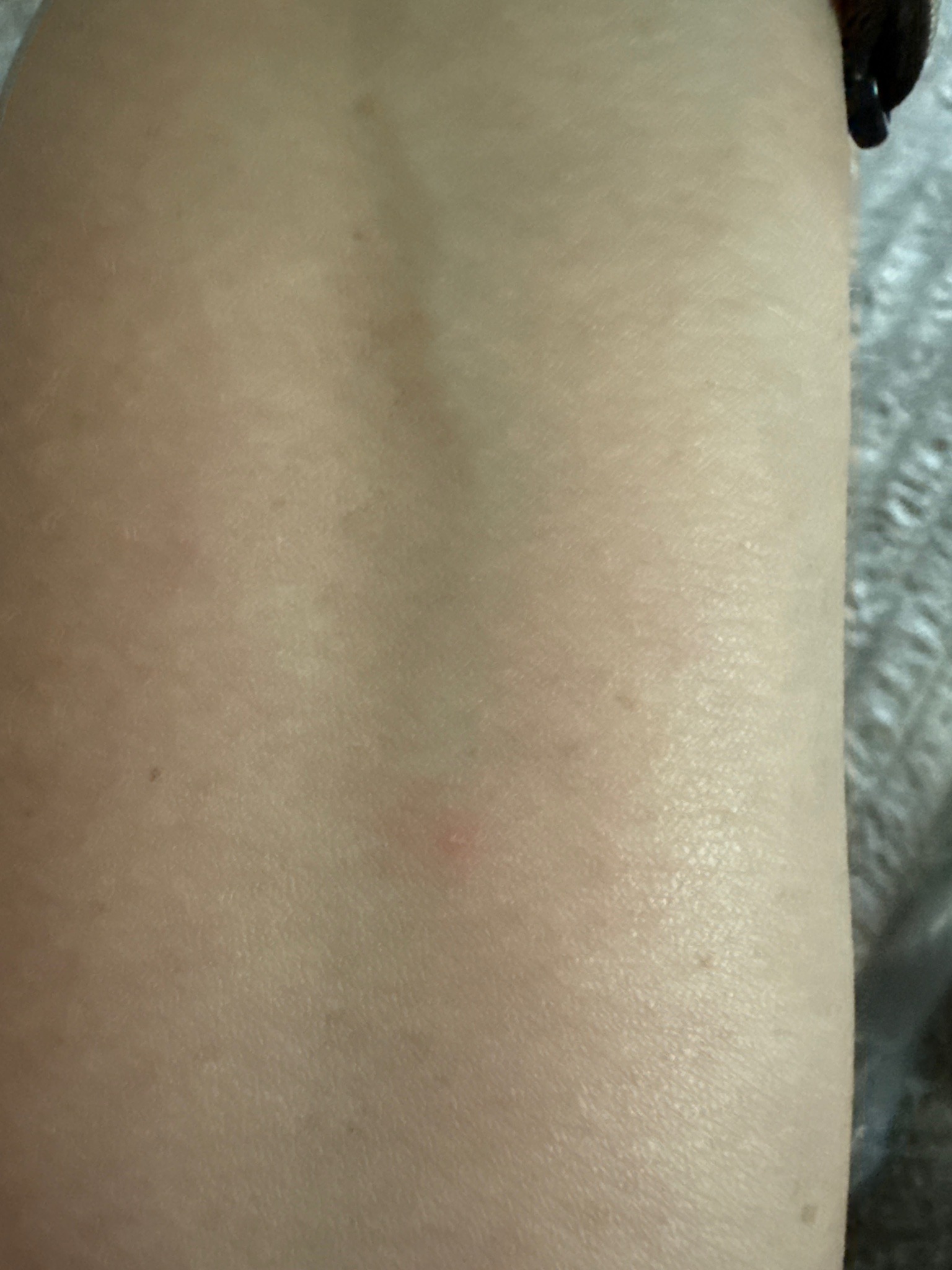 No insect/bug present