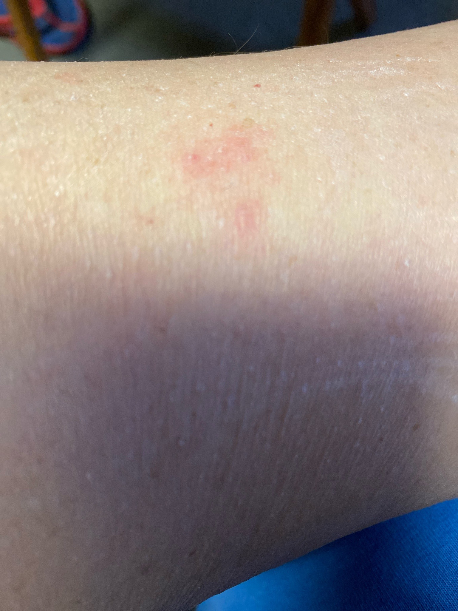 Not identifiable from the image; possible insect bite or skin irritation