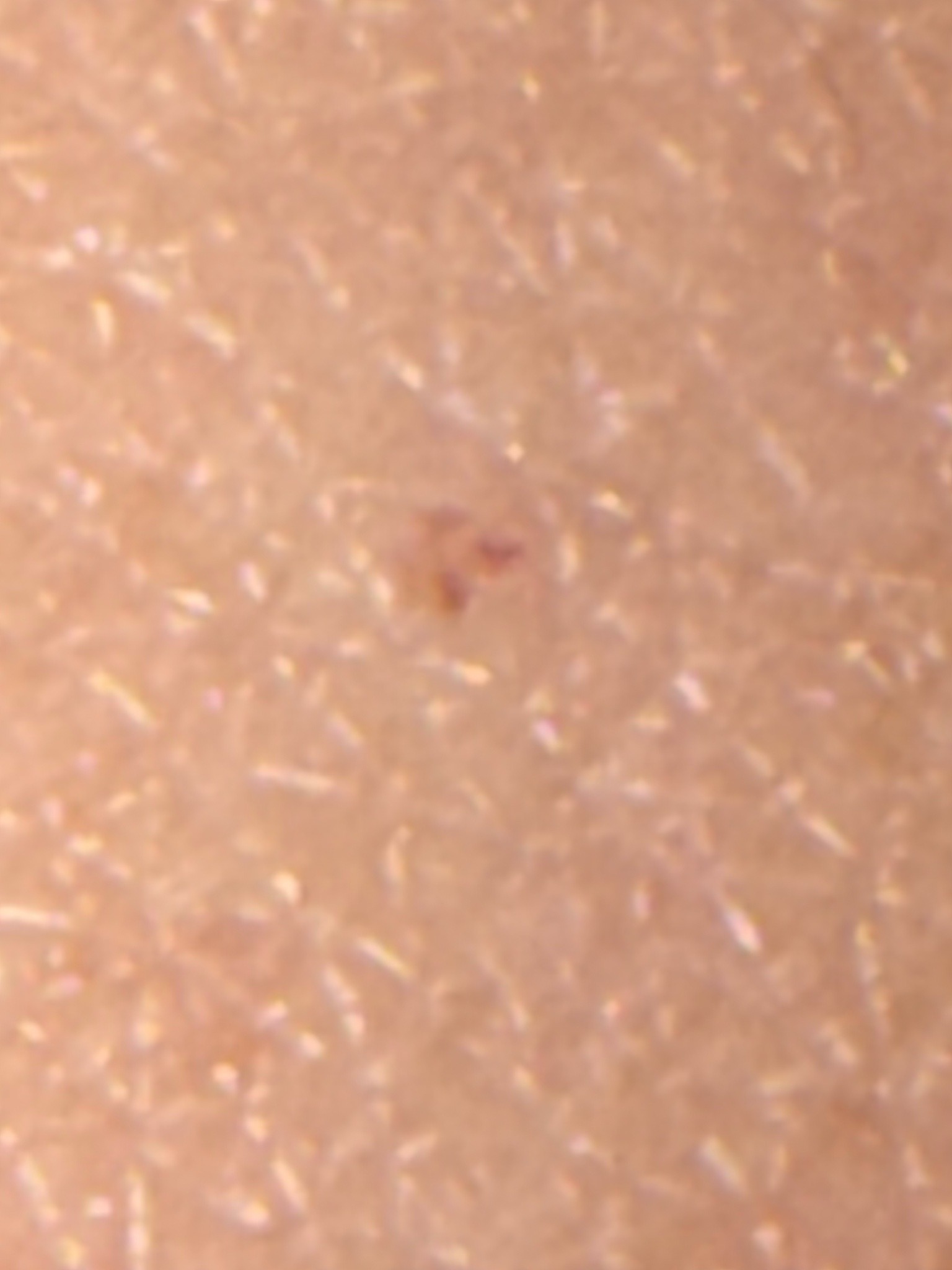 Possible chigger (red mite larva)