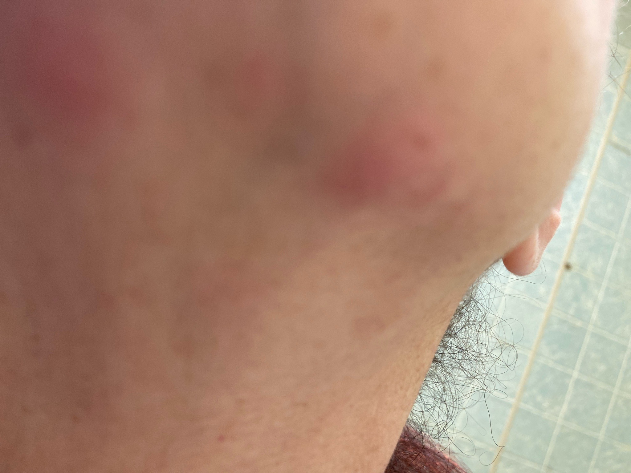 Possible mosquito bite; insect not visible