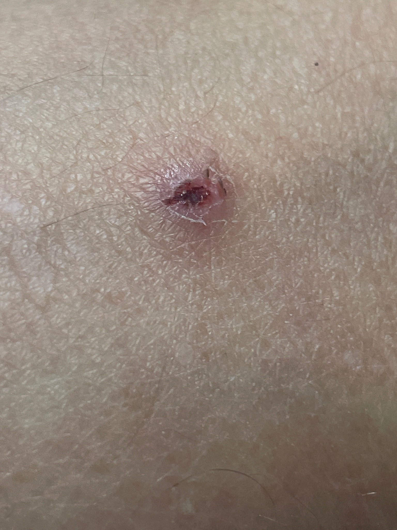 Unable to identify bug from wound image