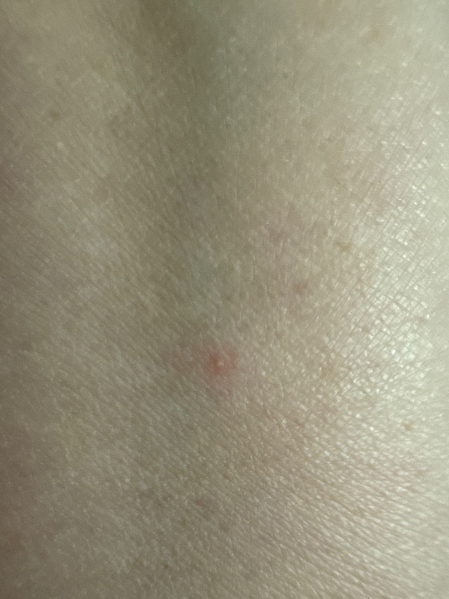 Undetermined Insect Bite/Sting