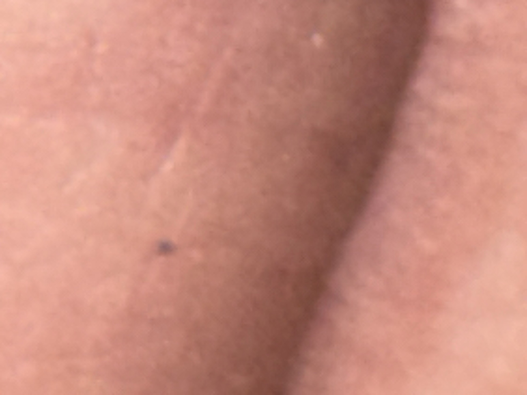 Unidentifiable (Possible Flea or Tick)