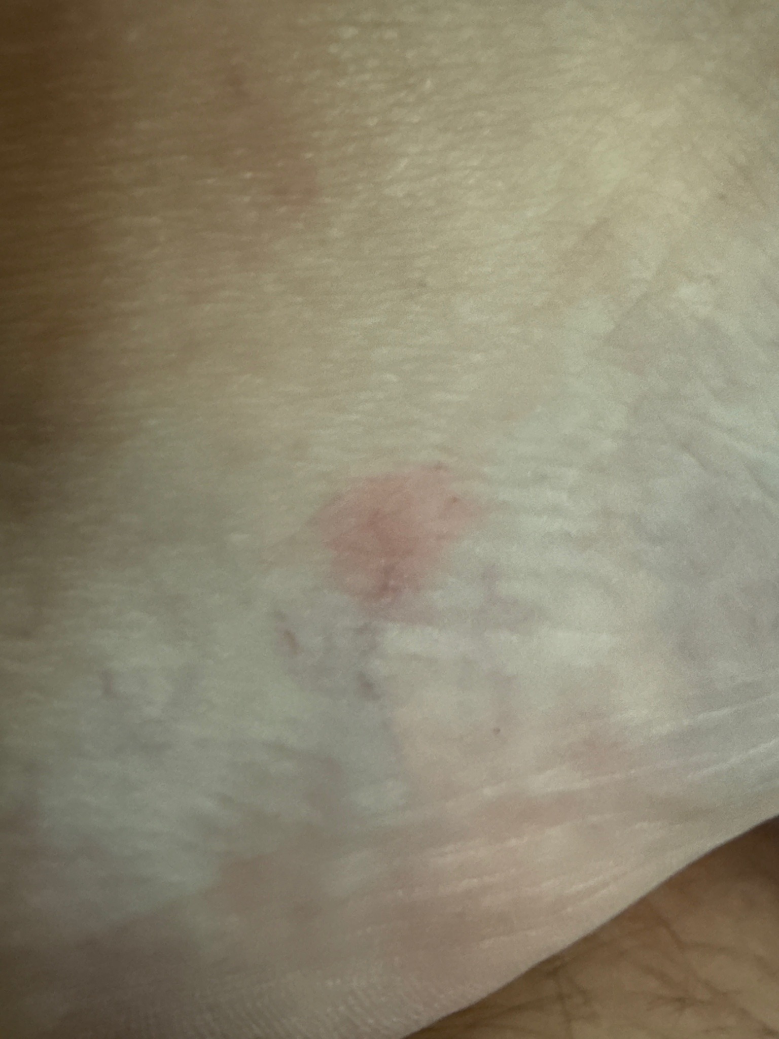 Unknown (Bite/Skin Irritation Only)