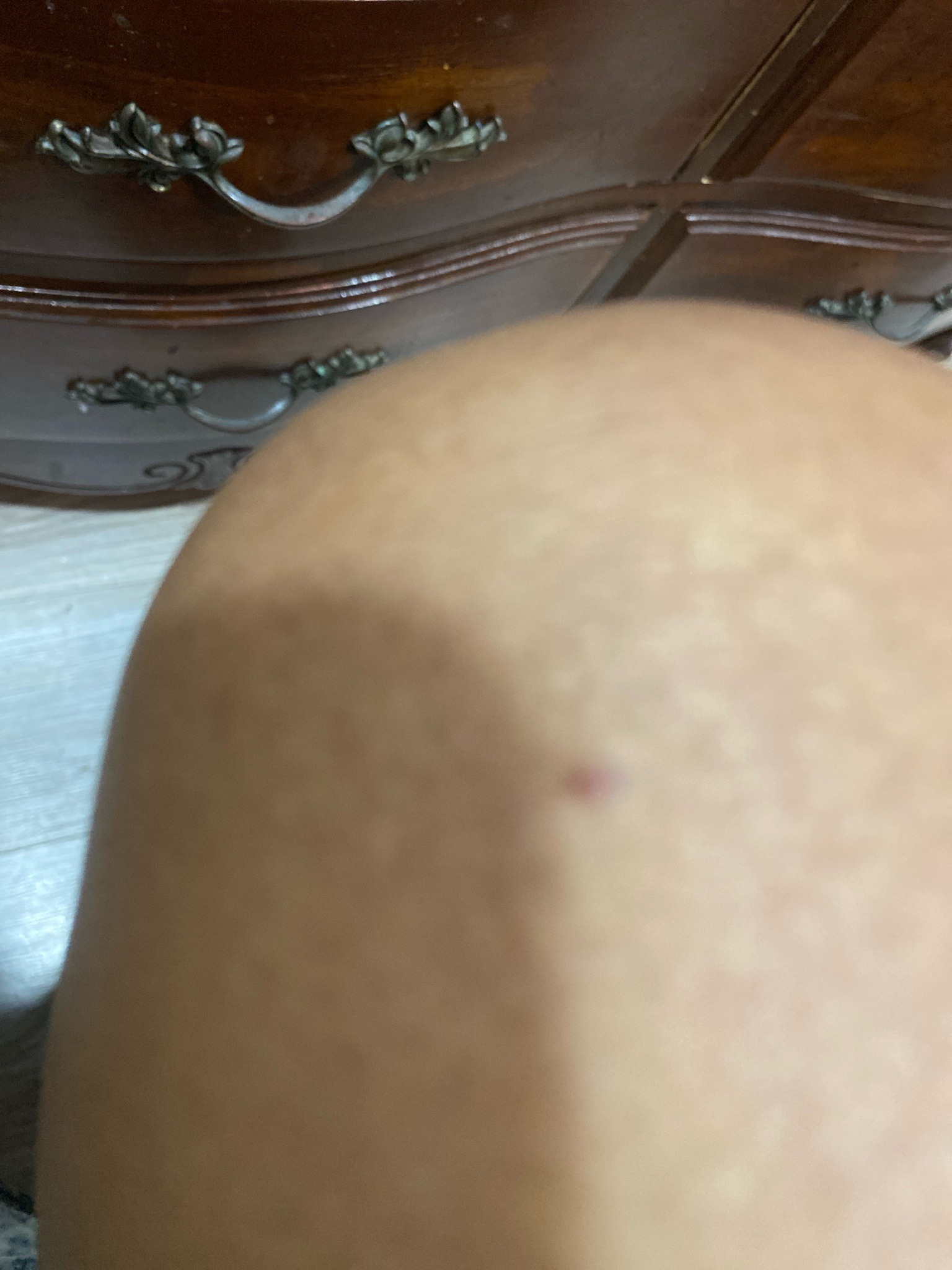 Unknown (Skin Mark)